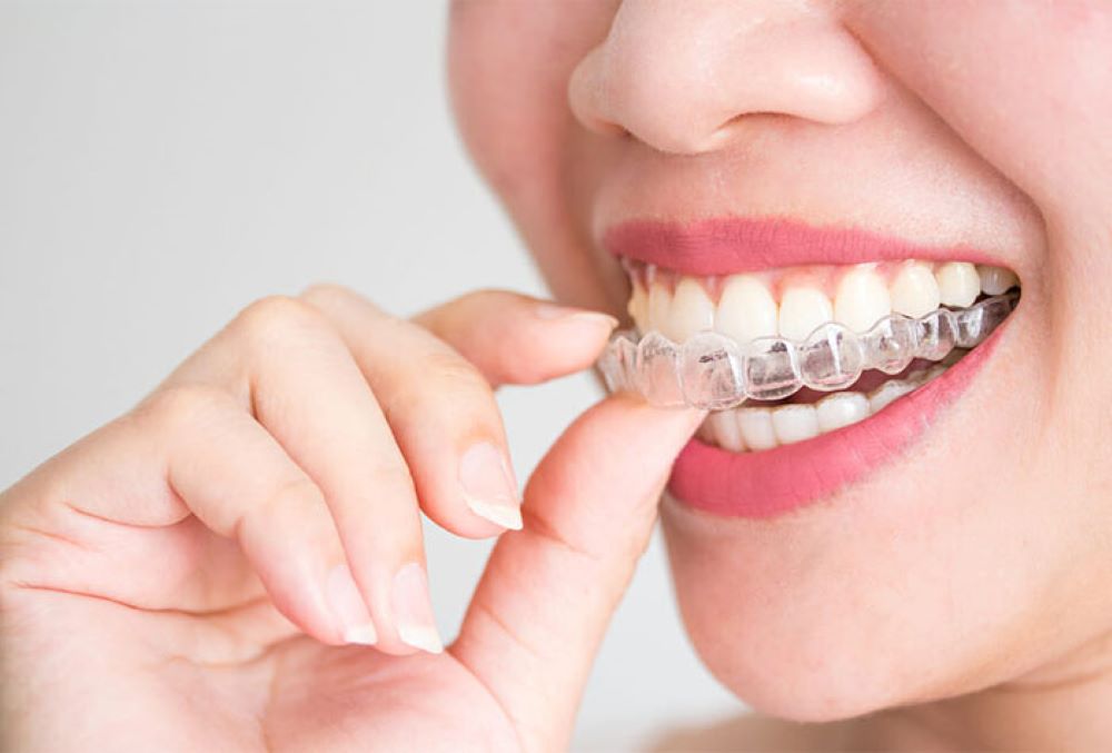 ΔΙΑΦΑΝΕΙΣ ΝΑΡΘΗΚΕΣ INVISALIGN ®